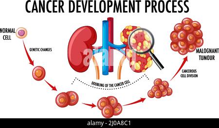 Diagramma che mostra l'illustrazione del processo di sviluppo del cancro Illustrazione Vettoriale