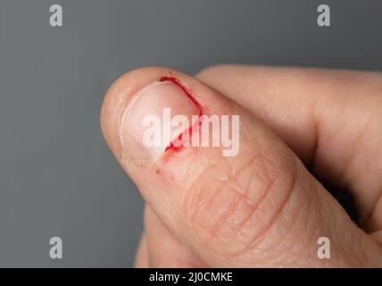 Pollice sanguinante da morsi unghie. Primo piano della mano femminile adulta con unghie masticate fresche e piccole ferite sulla pelle circostante. Foto Stock