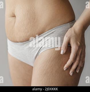 Primo piano corpo donna con segni di stiramento. Concetto di foto di alta qualità Foto Stock