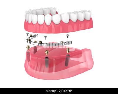 Installazione di overdenture rimovibile con ritenuta a barra supportata da impianti su backgroud bianco Foto Stock