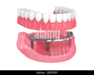 Installazione di overdenture rimovibile con ritenuta a barra supportata da impianti su backgroud bianco Foto Stock