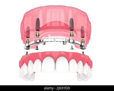 Installazione di overdenture rimovibile con ritenuta a barra supportata da impianti su backgroud bianco Foto Stock