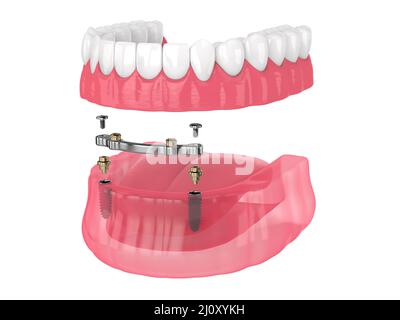 Installazione di overdenture rimovibile con ritenuta a barra supportata da impianti su backgroud bianco Foto Stock