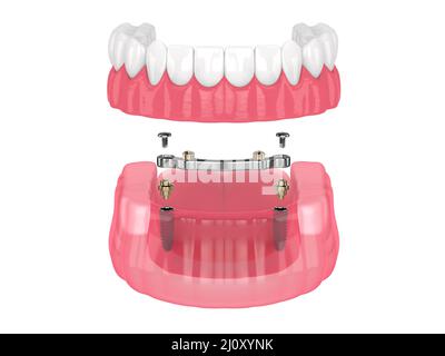 Installazione di overdenture rimovibile con ritenuta a barra supportata da impianti su backgroud bianco Foto Stock