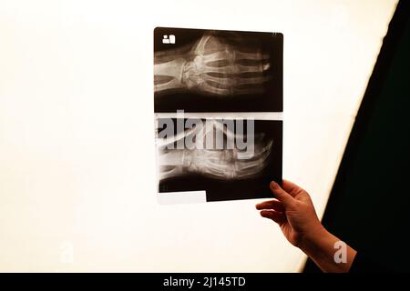 La mano dell'infermiere tiene una foto radiografica del braccio. Frattura del braccio, medicina. Foto Stock