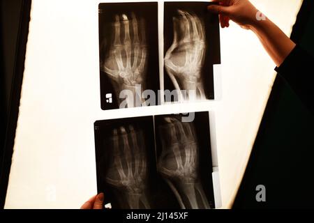 La mano dell'infermiere tiene una foto radiografica del braccio. Frattura del braccio, medicina. Foto Stock