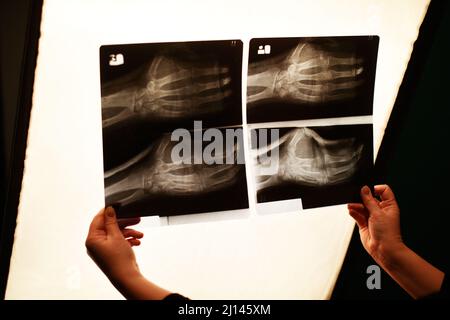 La mano dell'infermiere tiene una foto radiografica del braccio. Frattura del braccio, medicina. Foto Stock