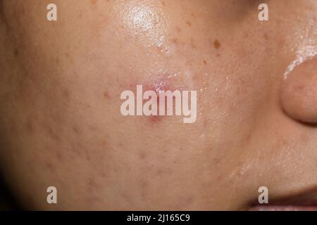 Singolo vulgaris dell'acne cystic sulla faccia oleosa della giovane donna del sud-est asiatico. Foto Stock