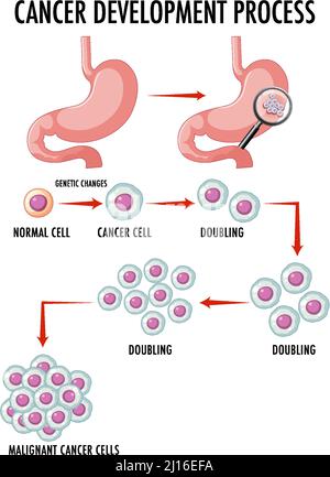 Diagramma che mostra l'illustrazione del processo di sviluppo del cancro Illustrazione Vettoriale
