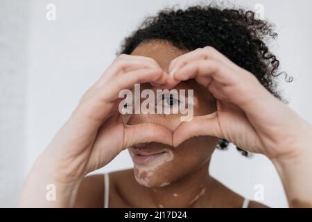 Donna con vitiligine che gestiva la forma del cuore con le mani Foto Stock