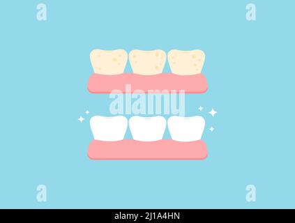 Denti che schiarisce salute e dente con placca gialla prima, dopo icona set. Illustrazione Vettoriale