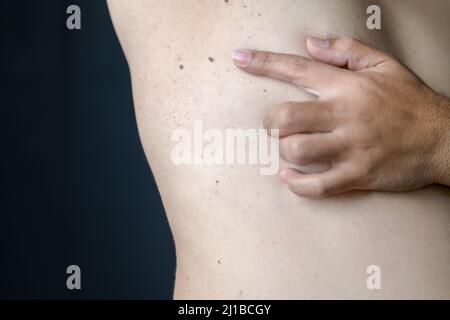 Chiuso di Skin Tag o Acrocordon sotto l'ascella su sfondo nero. Concetto di assistenza sanitaria Foto Stock