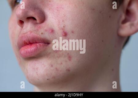 Un'immagine dell'acne sulla faccia di un adolescente . Pimples, cicatrici rosse e puntini neri su guance e mento. Il concetto di problema pelle, cura e bellezza. Foto Stock