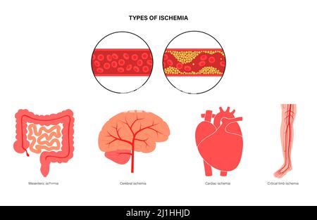 Tipi di ischemia, illustrazione Foto Stock