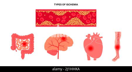 Tipi di ischemia, illustrazione Foto Stock