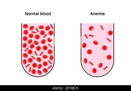 Sangue normale e sangue anemico, illustrazione Foto Stock