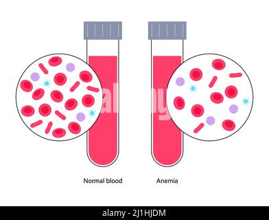 Sangue normale e sangue anemico, illustrazione Foto Stock