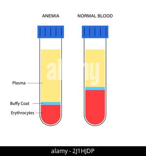 Sangue normale e sangue anemico, illustrazione Foto Stock