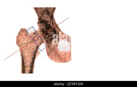 Foto ravvicinata del test di osteodensimetria femorale destro DEXA, che misura la densità ossea mediante raggi X, utilizzato per diagnosticare l'osteoporosi Foto Stock