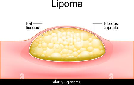 Lipoma tumori adiposi localizzati nei tessuti sottocutanei della pelle. Sezione trasversale di una pelle umana. Illustrazione vettoriale. Illustrazione Vettoriale