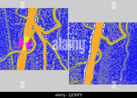 Stenosi dell'arteria iliaca Foto Stock