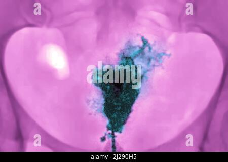 Cancro dell'utero Foto Stock