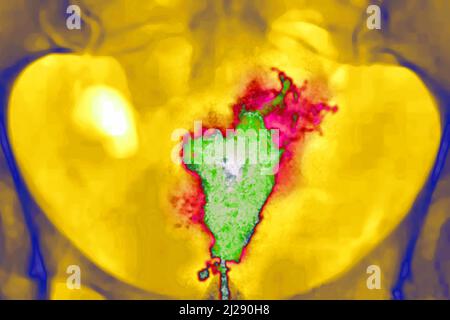 Cancro dell'utero Foto Stock