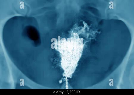 Cancro dell'utero Foto Stock