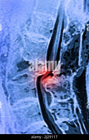 Traumatismo di dislocazione Foto Stock