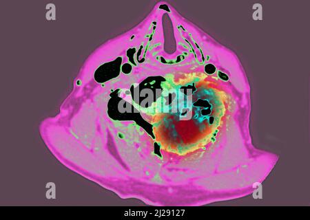 Tumore maligno localizzato sulle vertebre cervicali Foto Stock