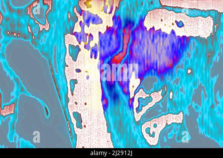 Tumore maligno localizzato sulle vertebre cervicali Foto Stock