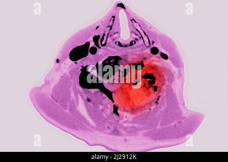 Tumore maligno localizzato sulle vertebre cervicali Foto Stock