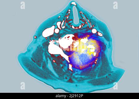 Tumore maligno localizzato sulle vertebre cervicali Foto Stock