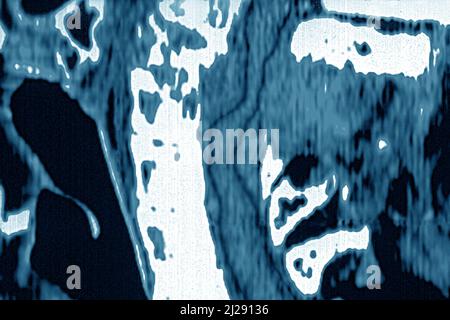 Tumore maligno localizzato sulle vertebre cervicali Foto Stock