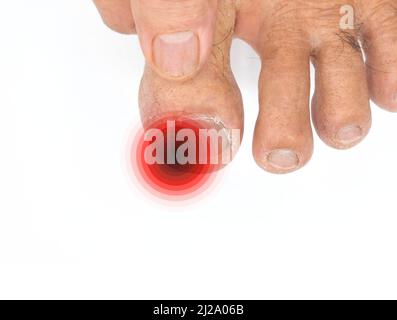 Infiammazione alla punta del toenail. Concetto di paronichia a punta grande del vecchio asiatico. Alluce doloroso. Foto Stock
