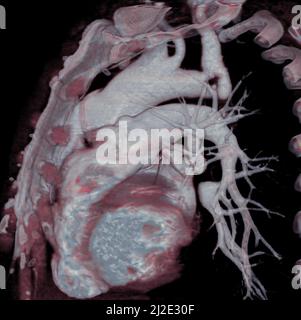 Arteria polmonare, scansione Foto Stock