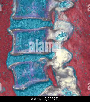 Disco herniated, scansione 3D ct Foto Stock