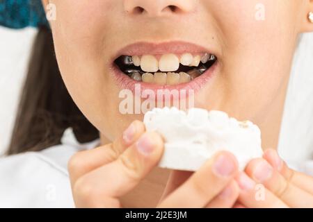 L'adolescente sta tenendo un modello del getto dentale all'inizio del trattamento ortodontico accanto ai suoi denti dopo che il trattamento è stato completato. Foto Stock