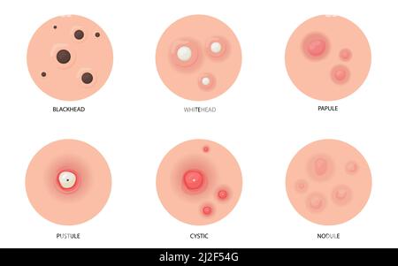 Tipi differenti di illustrazione piatta dell'acne regolata per disegno di fotoricettore. Cartoon skin pimples, blackheads e cisti isolato vettore illustrazione collezione. Pelle Illustrazione Vettoriale