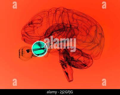 Nervo ottico, sezione del cervello vista dal lato. Lesione nervosa. Scarsa vista. Neurite ottica. Infiammazione, perdita parziale o totale della vista Foto Stock