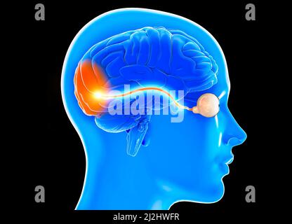 Nervo ottico, sezione del cervello vista dal lato. Lesione nervosa. Scarsa vista. Neurite ottica. Infiammazione, perdita parziale o totale della vista Foto Stock