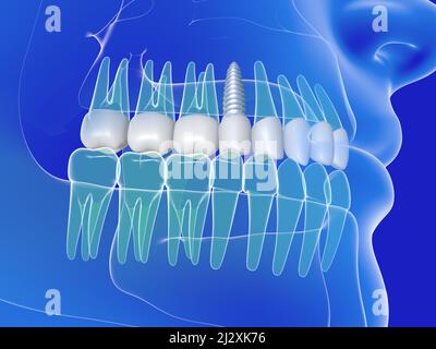 3d illustrazione di un impianto dentale. Immagine anatomica dei denti e della bocca, trasparente su sfondo blu. Foto Stock