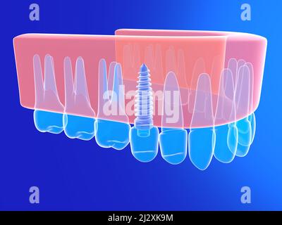 3d illustrazione di un impianto dentale. In un'immagine anatomica della protesi in vetro trasparente. Su sfondo blu. Foto Stock