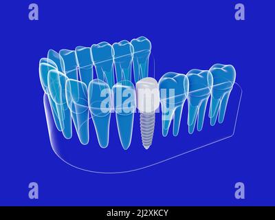 3d illustrazione di un impianto dentale grafico isometrico. Immagine anatomica della dentiera trasparente su sfondo blu. Foto Stock