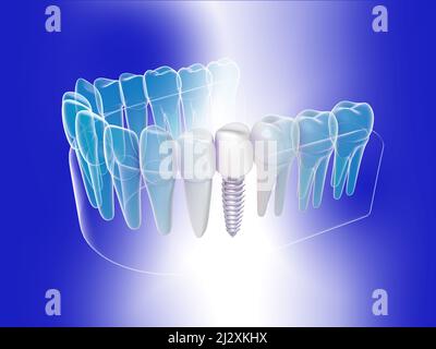 3d illustrazione di un impianto dentale grafico isometrico. Immagine anatomica della dentiera trasparente su sfondo blu. Foto Stock