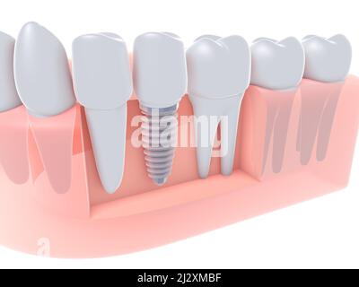 3d illustrazione di un impianto dentale inserito in una gomma, insieme a denti e molari. Vista anatomica della protesi dentaria su sfondo bianco. Foto Stock