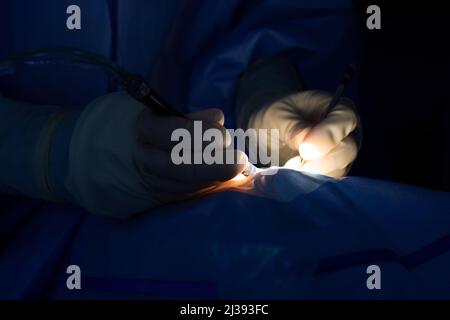 Primo piano delle mani dell'oftalmologo che operano su una cataratta, con una sonda di irrigazione e aspirazione e un bastone di ausilio. Guanti sterili e surgica blu Foto Stock