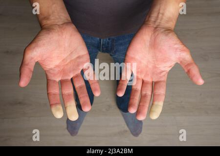 Uomo che mostra le mani con la sindrome di Raynaud, il fenomeno di Raynaud o la malattia di Raynaud Foto Stock