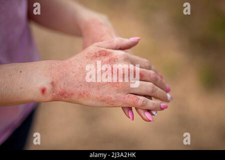 Primo piano dermatite sulla pelle, il male allergico rash eczema pelle del paziente, dermatite atopica sintomo pelle dettaglio texture, Fungus della pelle, il concetto de Foto Stock