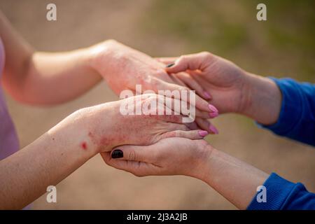 Primo piano dermatite sulla pelle, il male allergico rash eczema pelle del paziente, dermatite atopica sintomo pelle dettaglio texture, Fungus della pelle, il concetto de Foto Stock